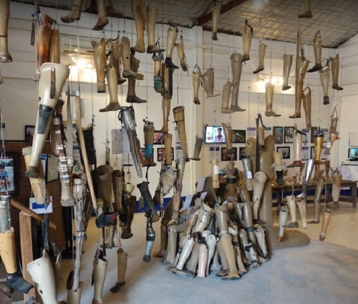 Hanging legs showing the victims of UXO and the need of Orthotic and Prosthetic